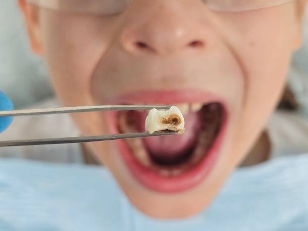 Best Emergency Wisdom Tooth Extraction in Moriches, NY